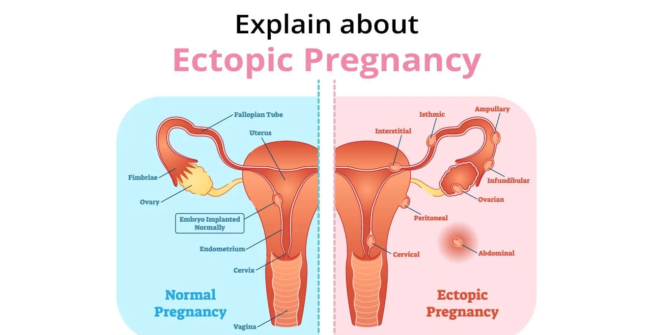 What are the Treatment Options for an Ectopic Pregnancy?
